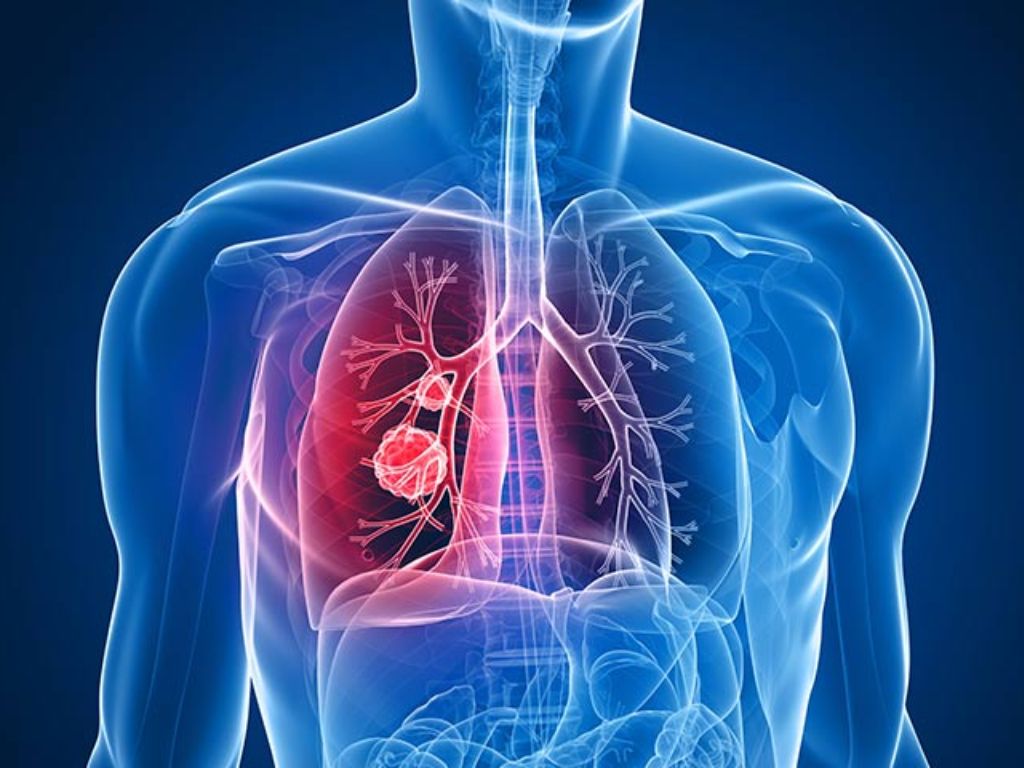 Test del sangue per migliorare lo screening del tumore al polmone